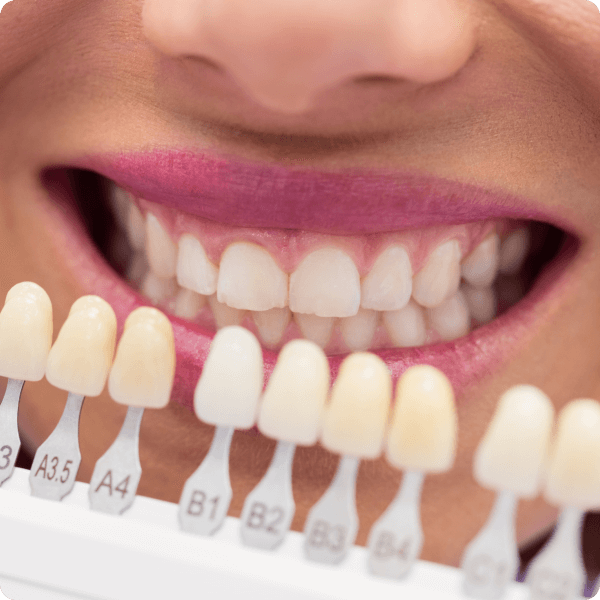 Отбеливание зубов - 5 проверенных способов отбелить зубы